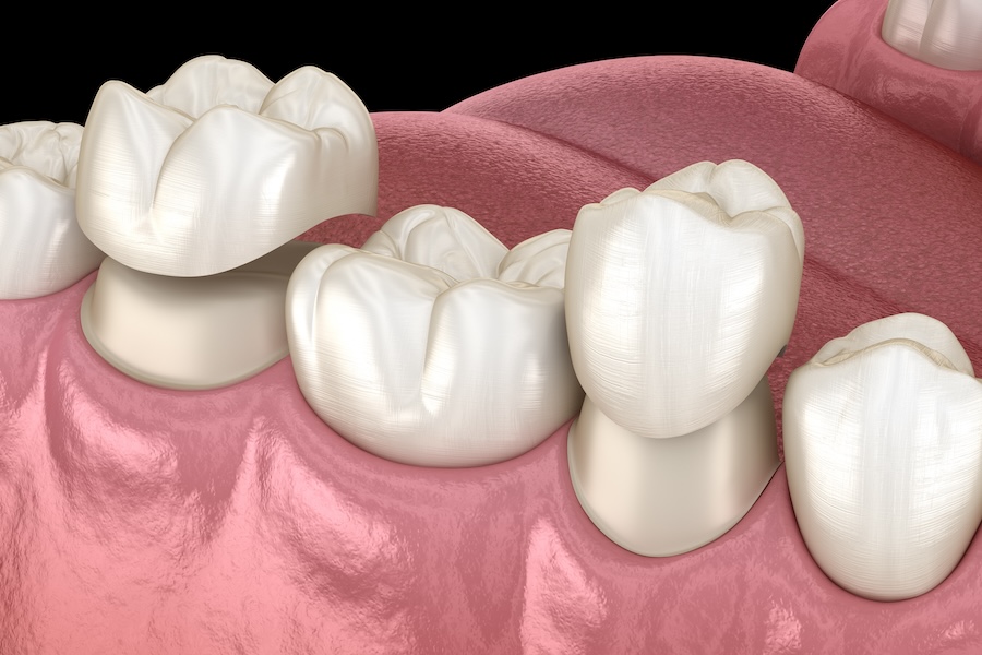 dental crown procedure, Prairie Dental Group, Eden Prairie dentist, dental crowns, tooth restoration, dental care, dental health, Dr. Benjamin Fenger, Dr. Jeffrey Moos, Dr. Cole Boerema, Dr. Erik Engelbrektson, Dr. James Watson