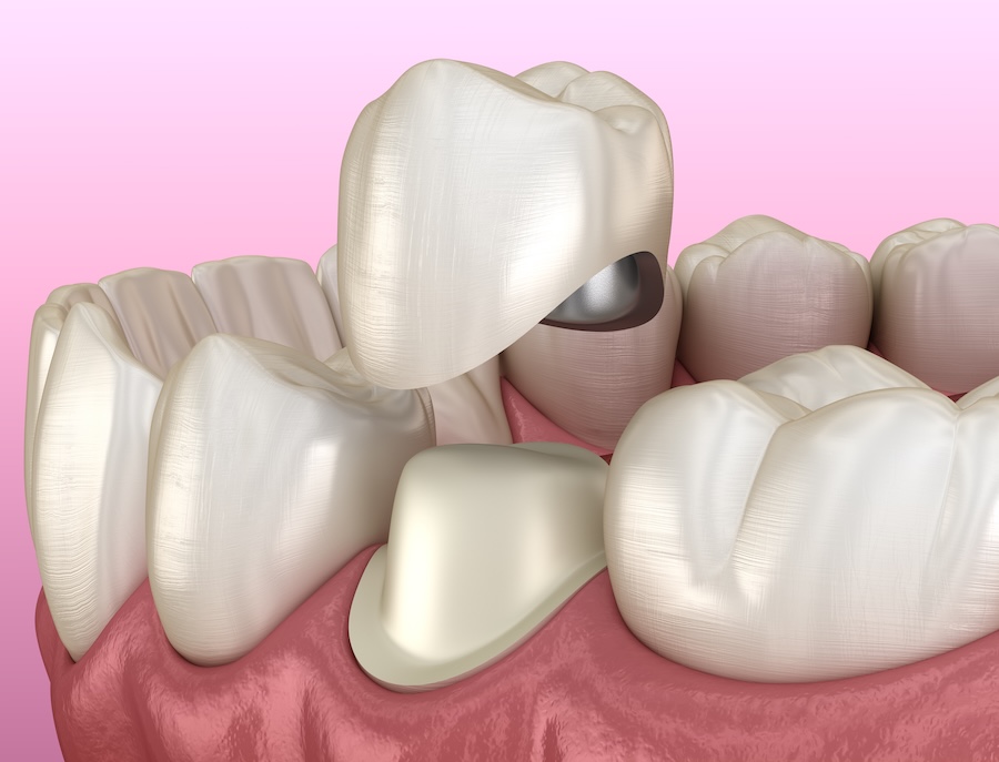 Metal ceramic dental crown, types of dental crowns